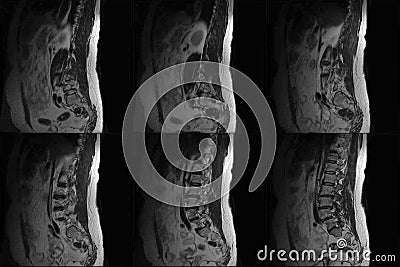 CT Computed tomography scans of human spine on a ultrasound computer monitor. Part three Stock Photo