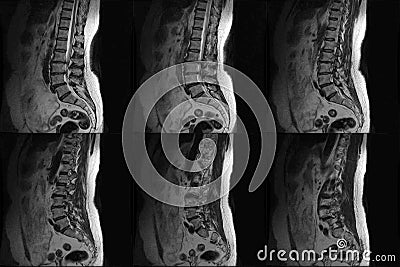 CT Computed tomography scans of human spine on a ultrasound computer monitor. Part two Stock Photo