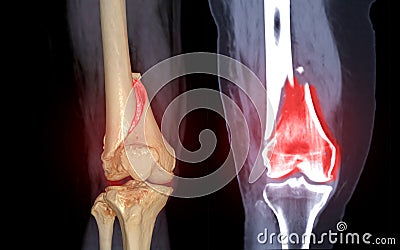 CT knee joint 3D rendering image Front view and Coronal view isolated on black background showing fracture Femur bone Stock Photo