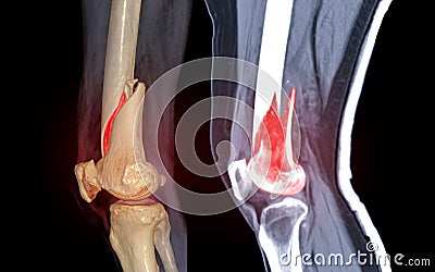 CT knee joint 3D rendering image lateral view and Sagittal view isolated on black background showing fracture Femur bone Stock Photo