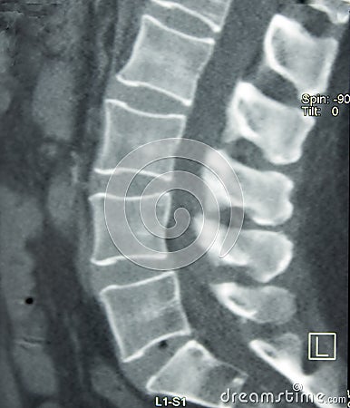 CT of Lumbar Spine Stock Photo