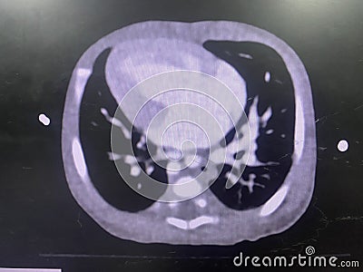 CT scan angiogram show dextrocardia the congenital heart disease Stock Photo