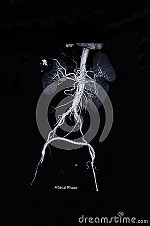 Ct scan angiogram (take photo from film x-ray) Stock Photo