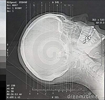 CT Scan Angles Stock Photo