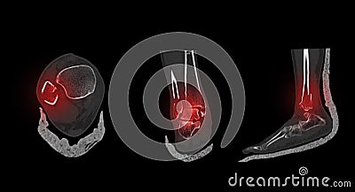 CT Scan ankle and foot or Computed Tomography of Ankle joint and Foot 3D Volume Rendering image showing fractured Tibia and fibula Stock Photo