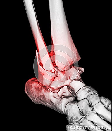 CT Scan ankle and foot or Computed Tomography of Ankle joint and Foot 3D Volume Rendering image showing fractured Tibia and fibula Stock Photo