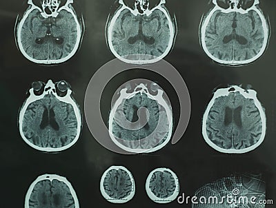 CT scan of brain Stock Photo