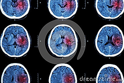 CT scan of brain with red area ( Imaging for hemorrhagic stroke or Ischemic stroke ( infarction ) concept ) Stock Photo