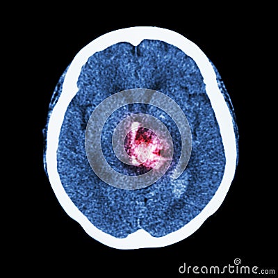 CT scan of brain : show hemorrhagic stroke Stock Photo