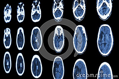 CT scan of brain show ischemic stroke and hemorrhagic stroke Stock Photo