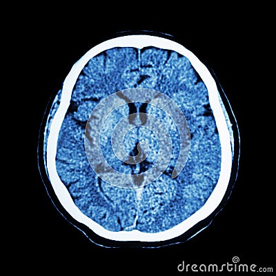 CT scan of brain : show normal human's brain ( CAT scan ) Stock Photo