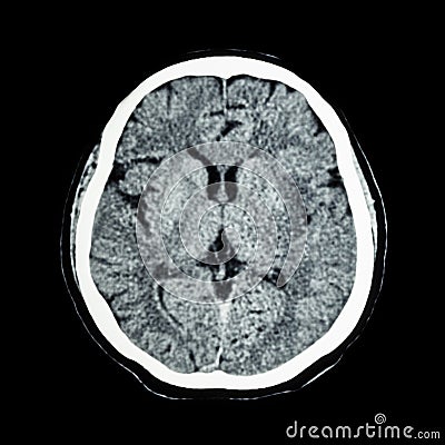 CT scan of brain : show normal human's brain ( CAT scan ) Stock Photo