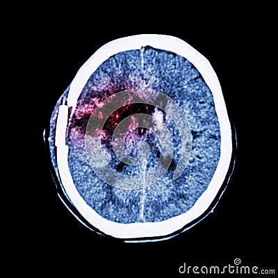 CT scan of brain : show old right basal ganglia hemorrhage with brain edema ( status post craniotomy ) ( Hemorrhagic stroke ) Stock Photo