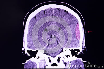 Brain CT scan, epidural hemorrhage Stock Photo
