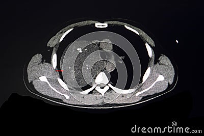 CT scan of a chest showing anterior mediastinal tumor Stock Photo