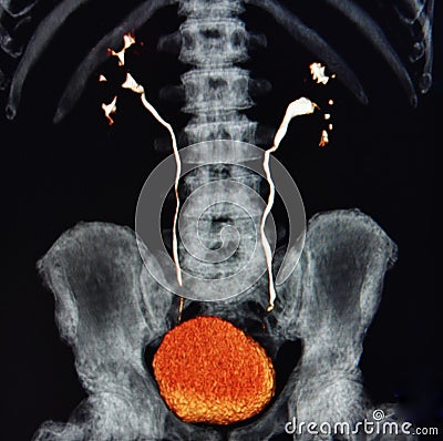 Ct scan 3d ct urography kidneys bladder colorful Stock Photo