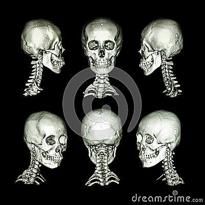 CT scan and 3D image. Normal human skull and cervical spine . all direction Stock Photo