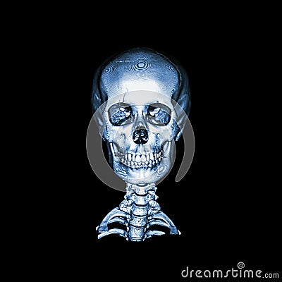 CT scan with 3D image of normal human skull and cervical spine . anterior - posterior view AP . Stock Photo