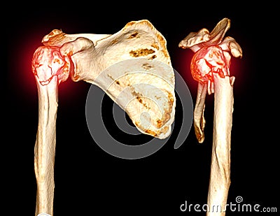 CT scan 3D rendering of shoulder joint showing fracture head of humerus Stock Photo
