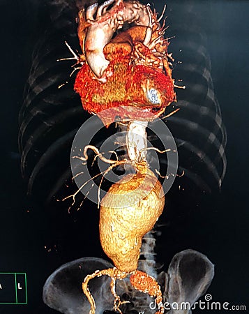 Abdominal aortic aneurysm Stock Photo