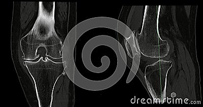 CT Scan of Knee joint for medical background Stock Photo