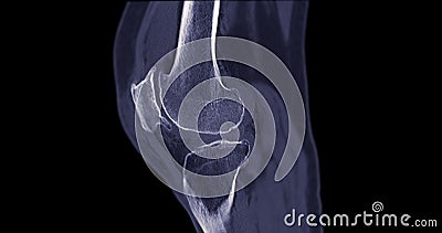 CT Scan of Knee joint for medical background Stock Photo