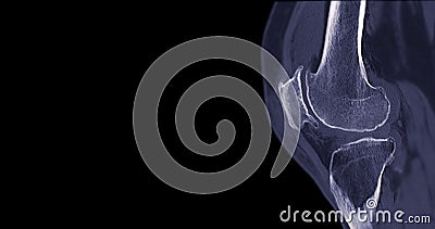 CT Scan of Knee joint for medical background Stock Photo