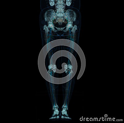 CT scan of lower extremity ,3D illustration of Femur bone , knee joint , leg and foot Cartoon Illustration