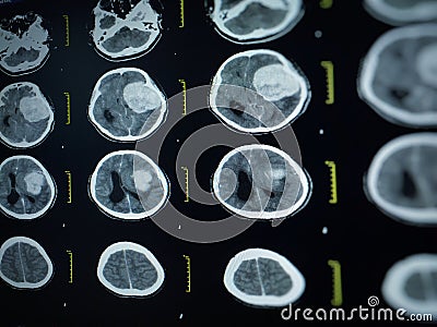 CT scan and MRI of brain : show cerebral infarct , intracerebral hemorrhage Stock Photo