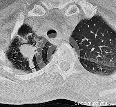 Ct scan right lung lower lobe carcinoma. Stock Photo