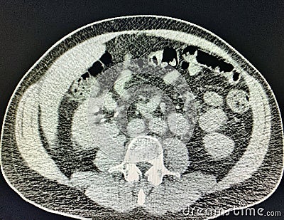 Ct scan right renal cyst collapse after drainage imaging Stock Photo