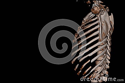 CT Scan Thoracic spine 3D finding The film shown thoracolumbar fracture injury after fall form height Stock Photo