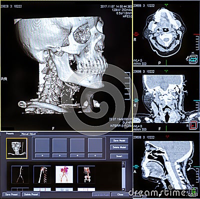 CT scans of human head Stock Photo