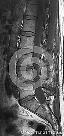 CT scans of human spine Stock Photo