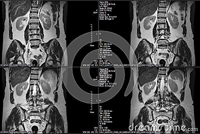 CT scans of human spine on a ultrasound computer monitor Stock Photo