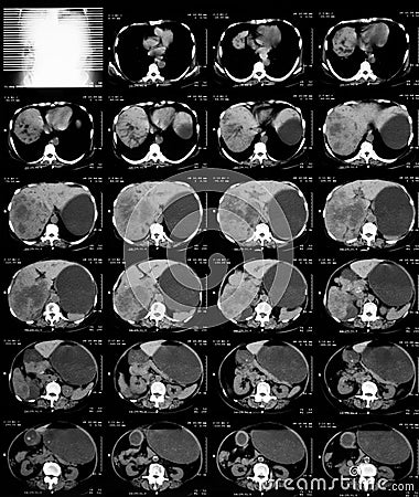 CT of upper abdomen. Stock Photo