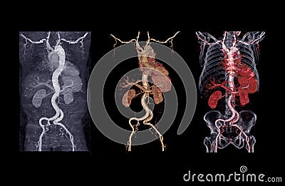 CTA abdominal aorta 3D rendering image showing aortic dissection Stock Photo