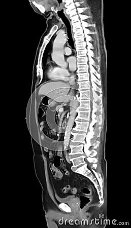 CTA of Aorta and Major Branches:.A comprehensive CTA scan showing the aorta and its major branches, providing clear visualization Stock Photo