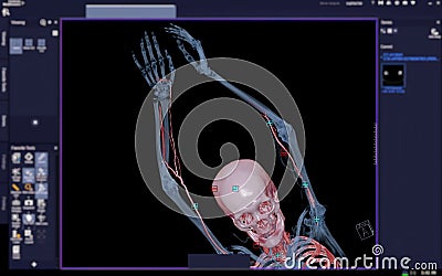 CTA brachial artery or CT scan of upper extremity or the Arm 3d rendering image on blurred screen Stock Photo