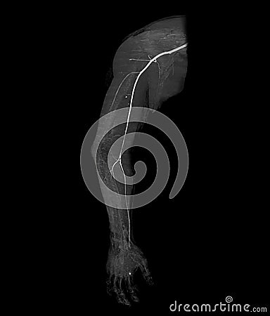 CTA brachial artery or CT scan of upper extremity 3D rendering image Stock Photo