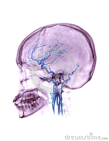 CTA brain or CT angiography of the brain . Stock Photo
