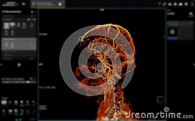 CTA Brain Vascular Imaging:.This image highlights a detailed 3D CTA scan of the brainâ€™s vascular network, showing clear Stock Photo