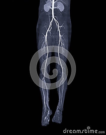 CTA femoral artery run off . Stock Photo