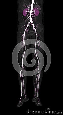 CTA femoral artery run off 3D rendering image. Stock Photo