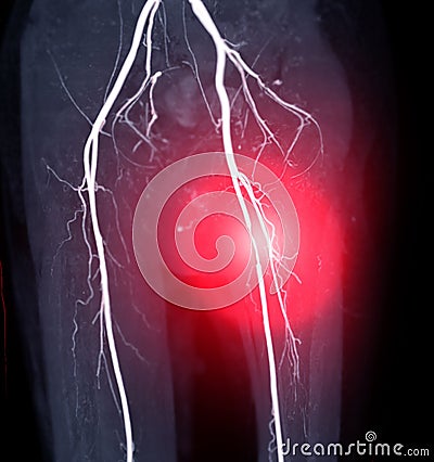 CTA femoral artery run off image of femoral artery . Stock Photo