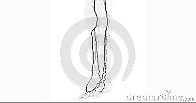 CTA femoral artery run off image of femoral artery for diagnostic Acute or Chronic Peripheral Arterial Disease Stock Photo