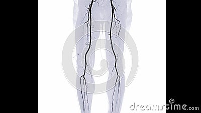 CTA femoral artery run off image of femoral artery for diagnostic Acute or Chronic Peripheral Arterial Disease Stock Photo