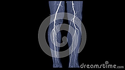 CTA femoral artery run off image of femoral artery for diagnostic Acute or Chronic Peripheral Arterial Disease Stock Photo