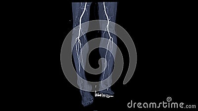 CTA femoral artery run off showing femoral artery for diagnostic Acute or Chronic Peripheral Arterial Disease Stock Photo