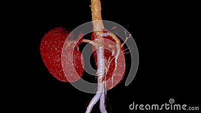 CTA Renal artery 3D is a medical imaging procedure using CT scans to examine the renal arteries It provides detailed images of the Stock Photo